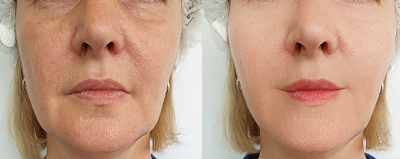 Why Schedule an Appointment for Non-Invasive Facelift